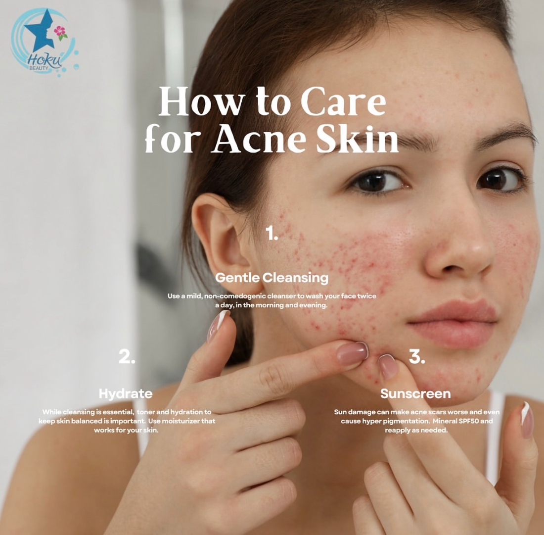 How to Care for Acne-Prone Skin: A Gentle, Consistent Approach